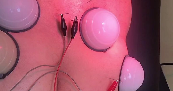 Electric Acupuncture